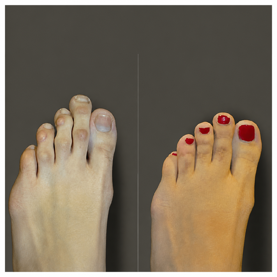 Customer showing her toe alignment progress